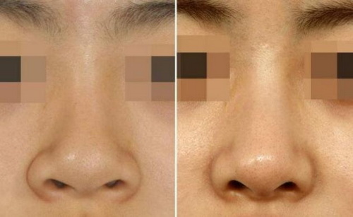 男性做完隆鼻手术后到底应该注意些什么呢？
