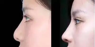 鼻孔塑形怎么做(如何通过鼻孔塑形实现完美鼻形？)