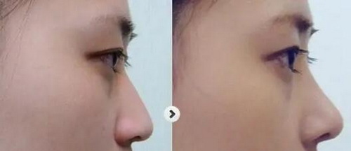 假体隆鼻手术让你永远不再烦恼担忧