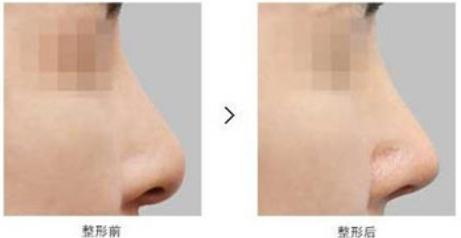 鼻翼短小怎么办(如何解决鼻翼短小的问题？)