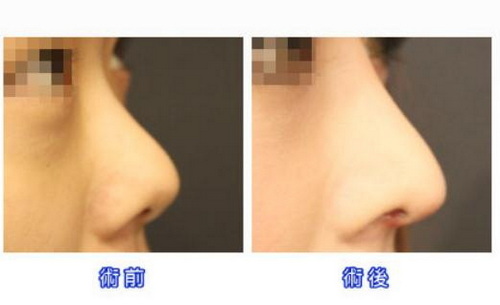歪鼻矫正手术后要多长时间康复