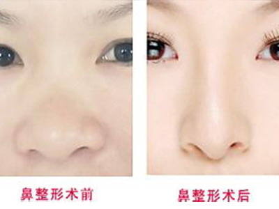 膨体隆鼻价格是多少呢？贵不贵？
