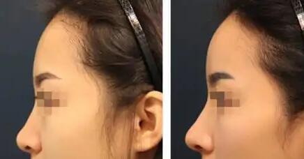 女性隆鼻术后多久可以化妆比较好呢？