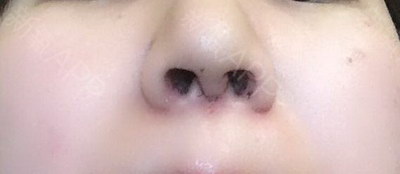 鼻孔不通畅是什么原因