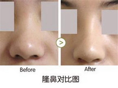 做完鼻子最晚几天拆线(鼻子最晚几天拆线？)