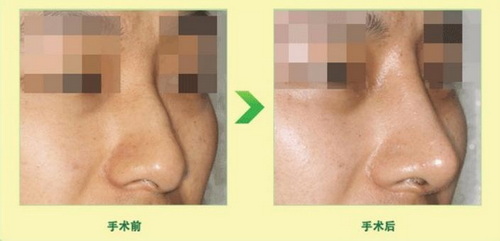 泉州鼻子的整形(泉州鼻子整形术)