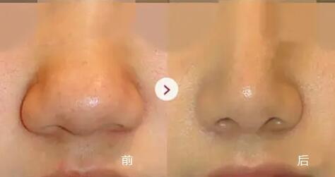 玻尿酸可以坚持多久(玻尿酸隆鼻可以坚持多久)