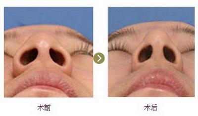 鼻综合假体显形(什么是鼻综合假体？)