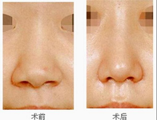 耳软骨隆鼻体检哪些项目