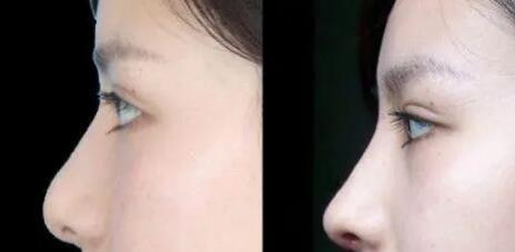 鼻翼缩小多久能看到效果(鼻翼缩小多久看到效果)
