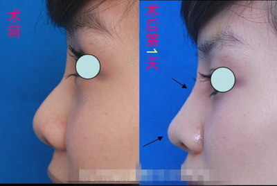 鼻骨矫正所需要的费用是多少