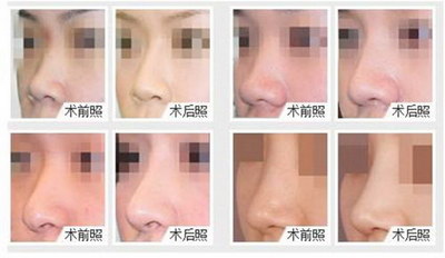 深圳缩小鼻头要多少钱_深圳缩小鼻头多少钱