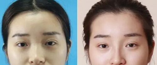 玻尿酸填充鼻子红肿期多久(玻尿酸填充鼻子红肿)