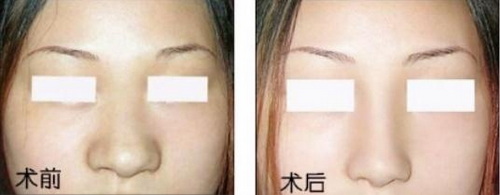 做埋线隆鼻的步骤及注意事项都有哪些呢？