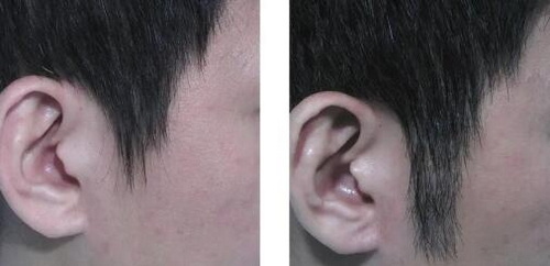 鬓角毛发怎么永久去掉_女生鬓角毛发怎么去掉