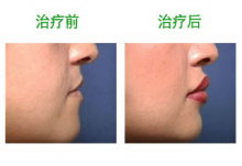 嘴唇两边的纹是什么纹
