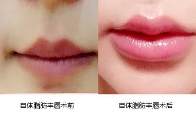 上嘴唇短一笑就露牙怎么回事(嘴唇短一笑就露牙的原因及解决方法)