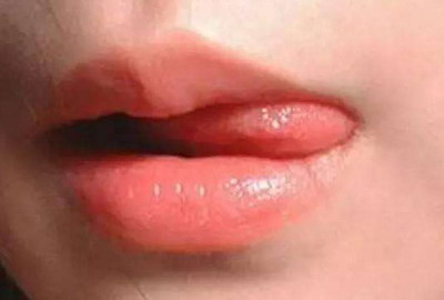 玻尿酸丰唇价格是多少价钱一针呢？