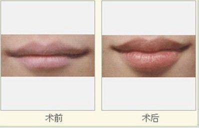嘴角有斑是什么原因怎么办_嘴角上方法令纹那一跳一跳的