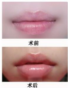 唇腭裂分级机(什么是唇腭裂？)