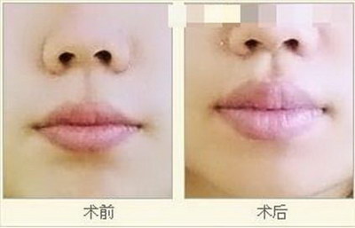 舌侧隐形矫正对牙齿有损伤吗？