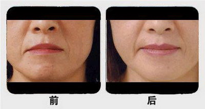 嘴角边上的纹叫什么_怎样祛除嘴角皱纹