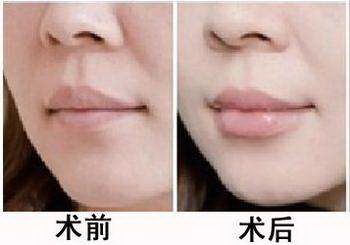 愿你嘴角永远保持微笑_嘴角法令纹怎么淡化