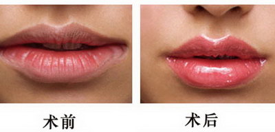 上火口唇疱疹的治疗(什么是火口唇疱疹)