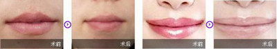 半永久纹唇会显老气吗(纹唇的过程)