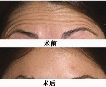 如何消除脸上泪沟纹纹