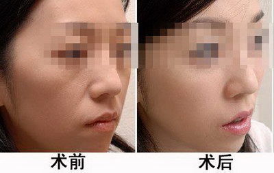 门牙上有裂纹会断吗_全瓷门牙的使用寿命有多长