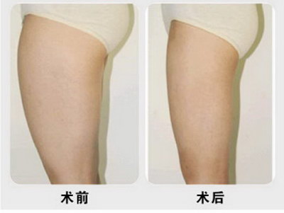 有做过自体脂肪丰臀的吗(自体脂肪丰臀是什么？)