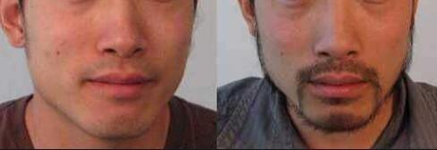 脱胡须用什么方法最好(为男士推荐更好的脱胡须方法)