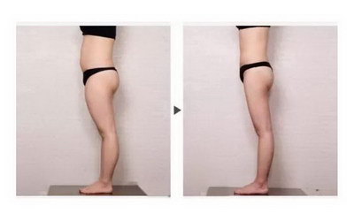 有没有哺乳期打瘦脸针的宝妈