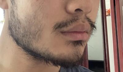 长春脱络腮胡(脱络腮胡的好处)