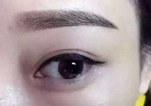 我眉间有一条竖纹想去除_打了眉间除皱针什么时候有效果