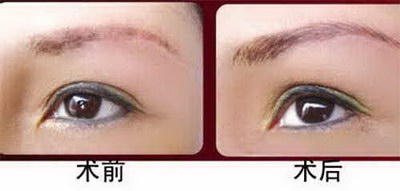 眉毛突然脱落是什么原因造成的(眉毛突然脱落没了是什么原因)