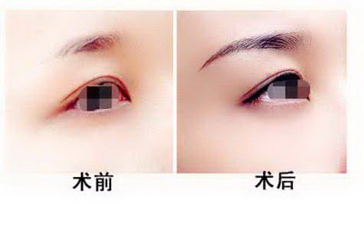 怎么减少眉间竖纹_怎样除眉间八字纹
