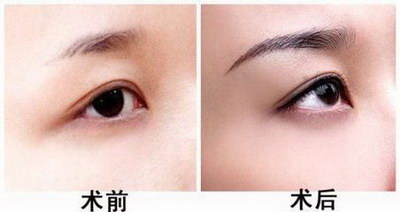 纹眉之后可以洗脸吗[切眉之后多久可以纹眉]