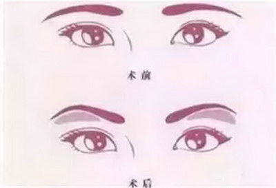 做了提眉术后多久可以纹眉(提眉术后可以纹眉吗？)
