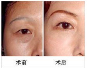 纹眉后眼睛肿怎么办_眼睛纹路命运