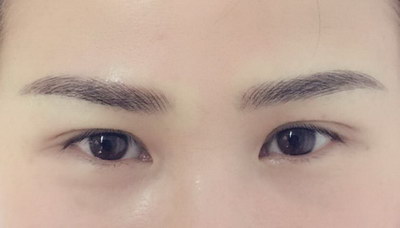 眉毛外伤局部缺失如何治疗