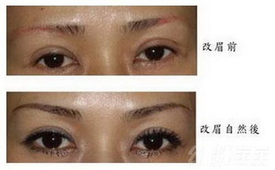 提眉手术疤痕多久能消除(提眉手术疤痕多久能消失)