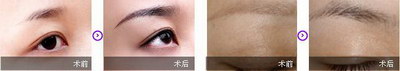 做了切眉手术后有什么后遗症(切眉手术后的可能后遗症)