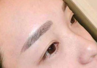 提眉手术几天能恢复「提眉手术后几天恢复好」