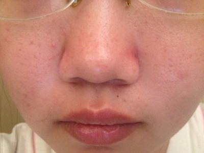 额头上的抬头纹要怎样才能消除
