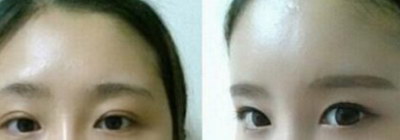 自体脂肪丰脸维持多久(自体脂肪丰脸，维持多久？)