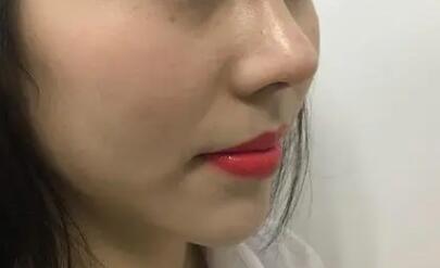 线雕脸部凹陷能恢复吗(线雕脸部凹陷后多久恢复)