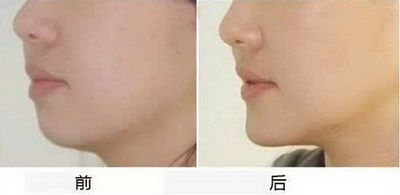 自体脂肪丰苹果肌需要多少钱？