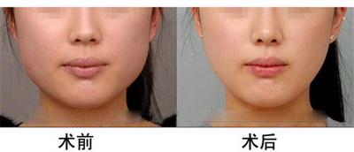 咬肌疼痛怎么恢复,不能嚼东西吃什么药(不得不面对的咬肌疼痛)